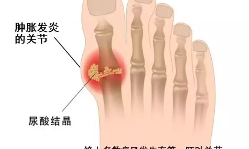 痛风的人能吃什么营养品-痛风患者食物营养价值网—知名的痛风吃什么营养品好网站,分享痛风吃什么营养品对身体好知识